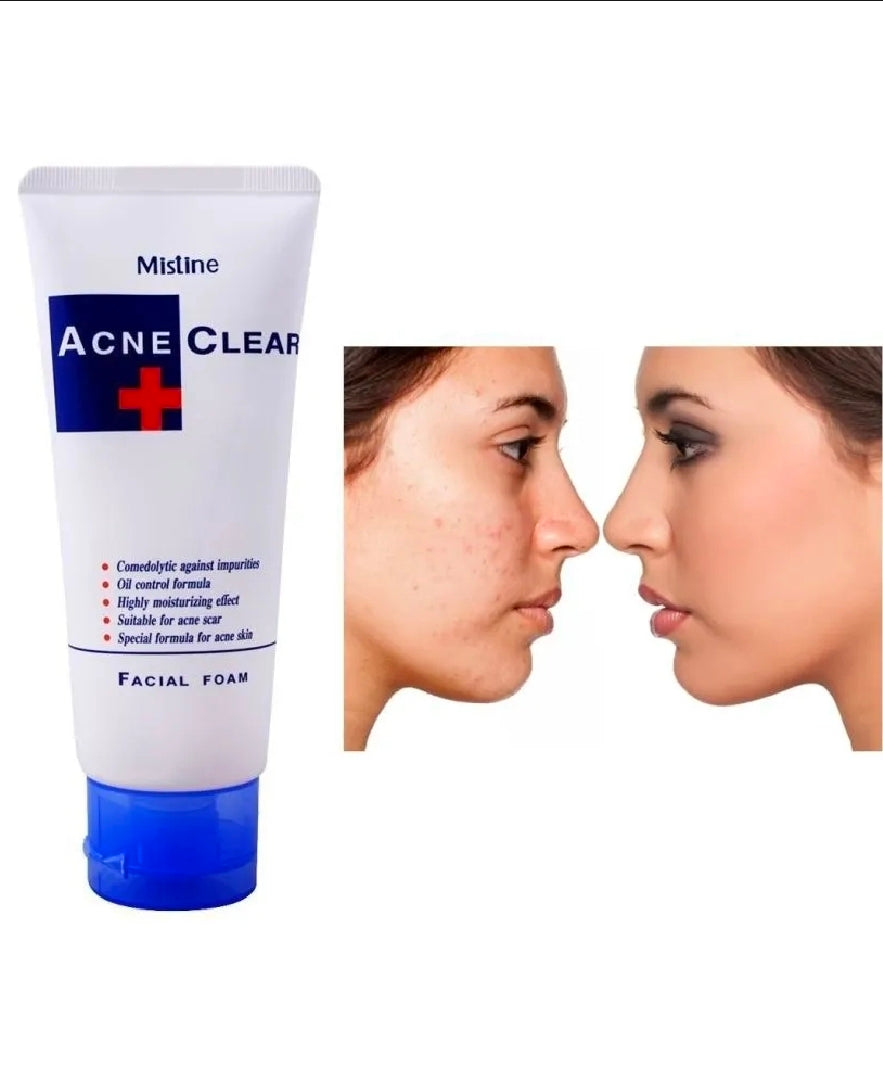 Mistine Acne Clear Facial Foam (85g) - Oil Control & Acne Care Face Wash